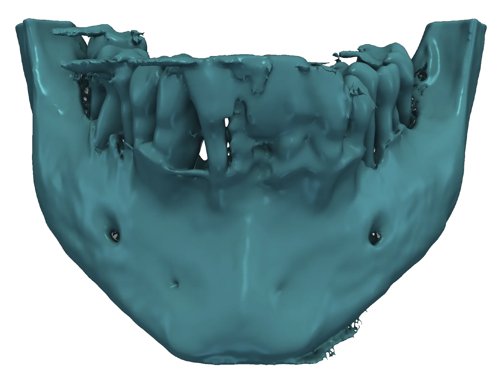Conventional threshold segmentation of a lower jaw: bone and teeth merge into one noisy surface.